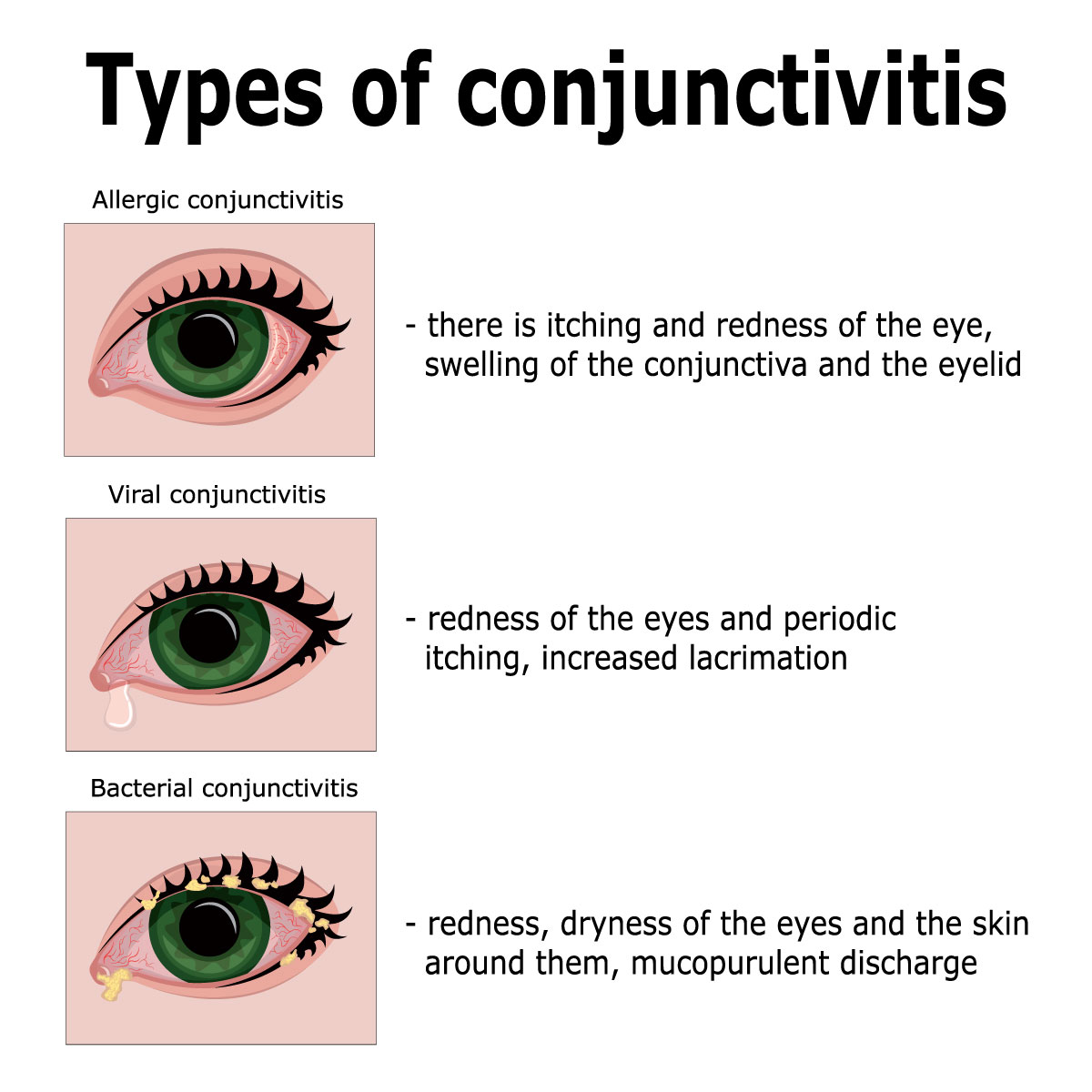 Conjunctivitis