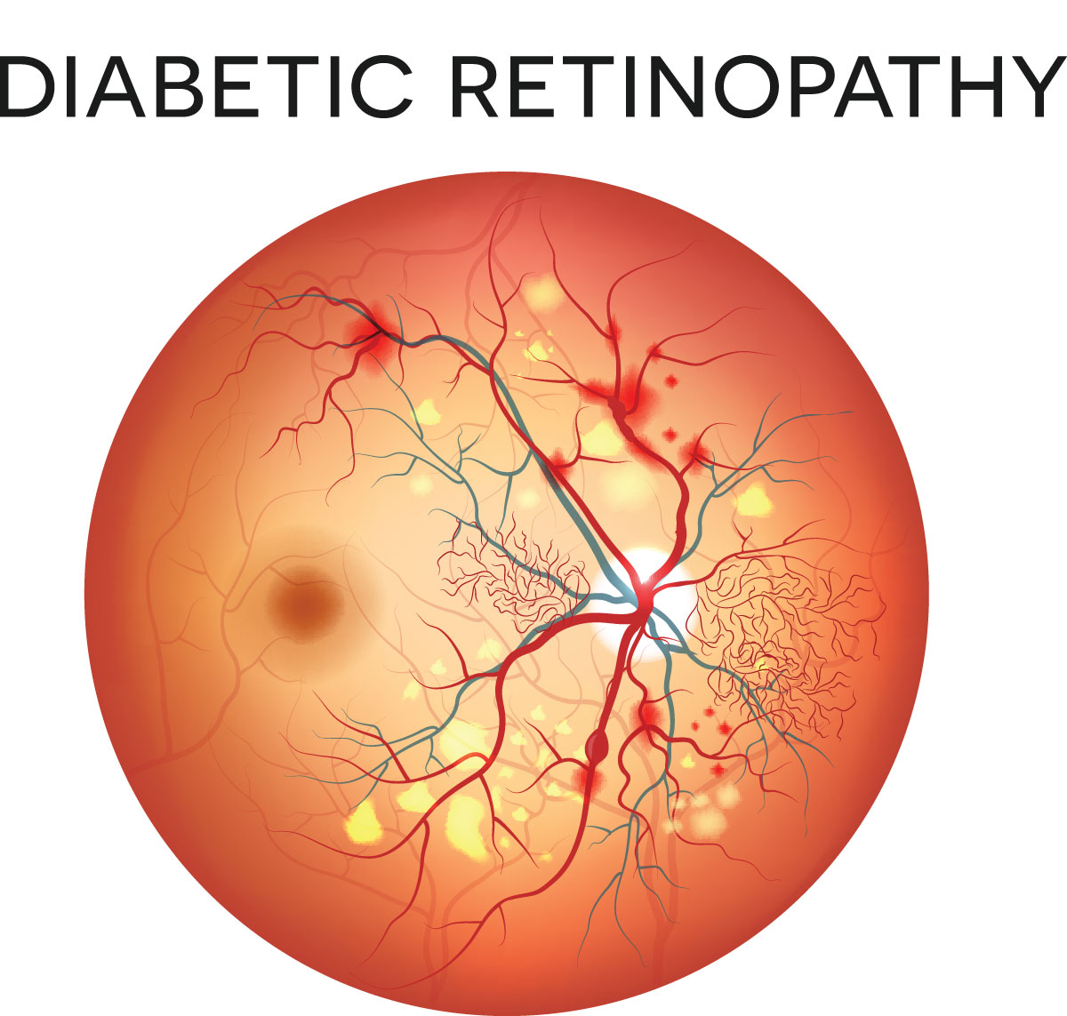 Diabetic Eye Disease