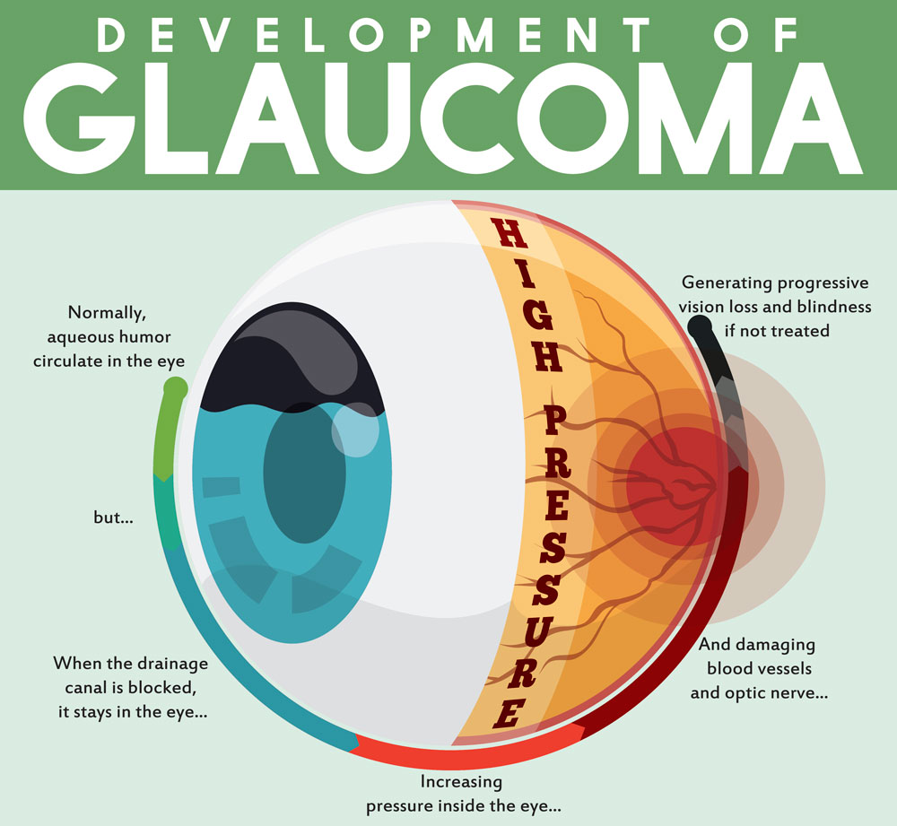 Glaucoma